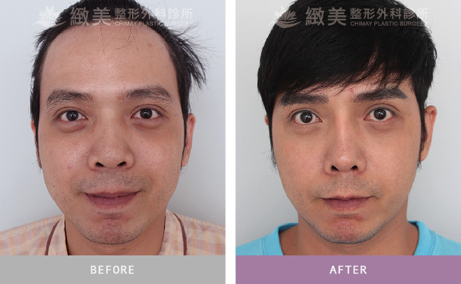 韓式立體隆鼻術後 1年 