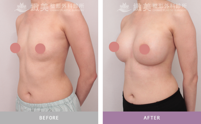 珍珠波隆乳 術後1個月 