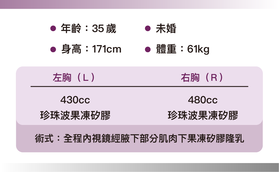 珍珠波隆乳 術後1個月 