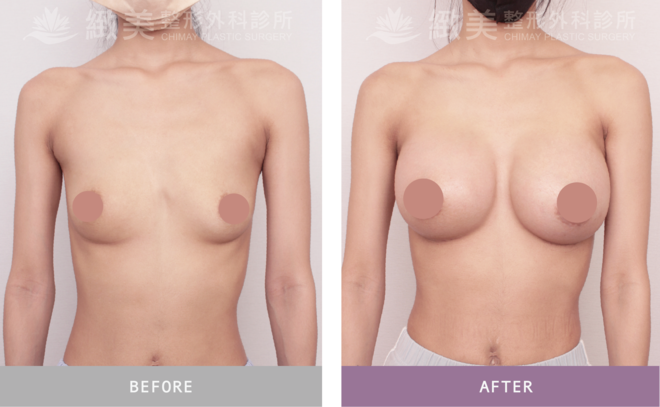 Xtra女王波隆乳 術後1個月