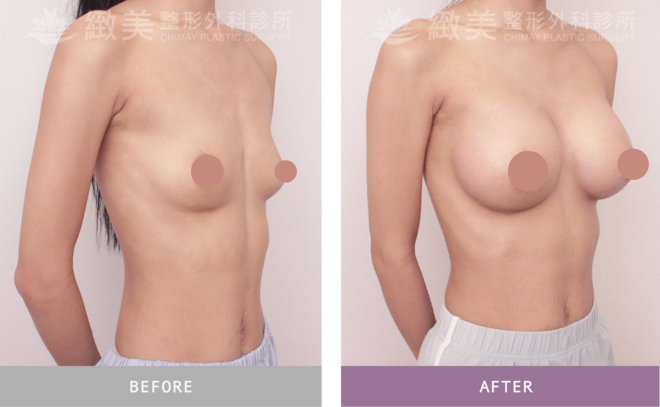 Xtra女王波隆乳 術後1個月