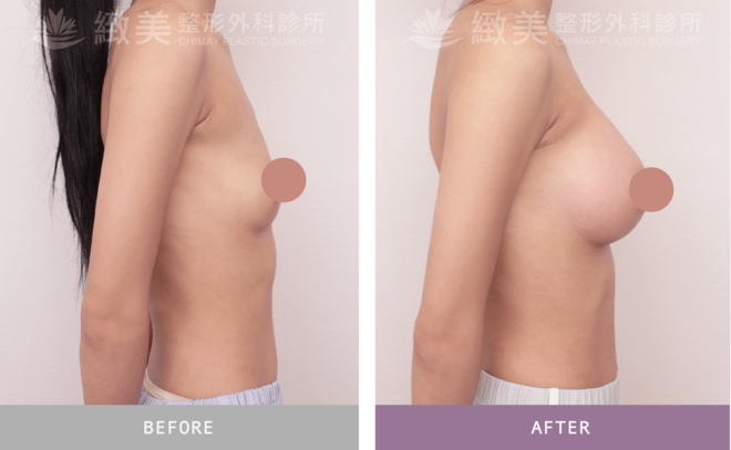 Xtra女王波隆乳 術後1個月