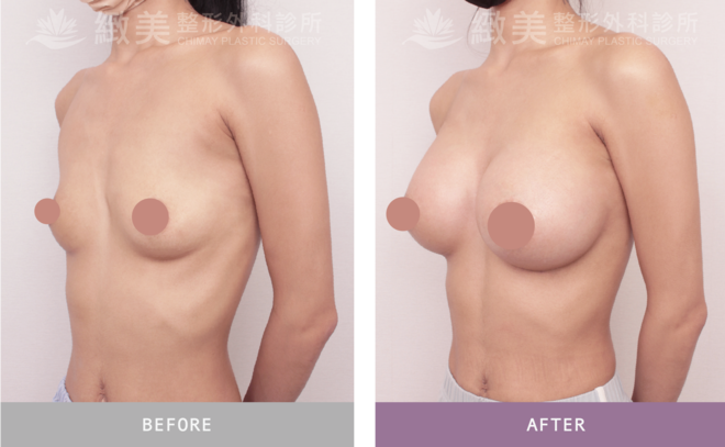 Xtra女王波隆乳 術後1個月