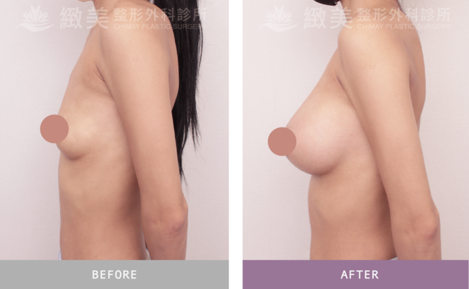 Xtra女王波隆乳 術後1個月