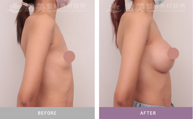魔滴2.0隆乳 術後1個月