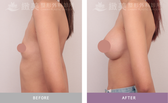 魔滴2.0隆乳 術後1個月