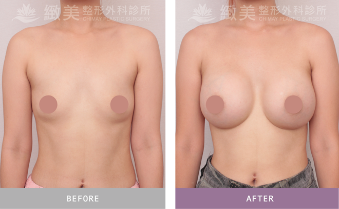 盈波隆乳 術後1個月