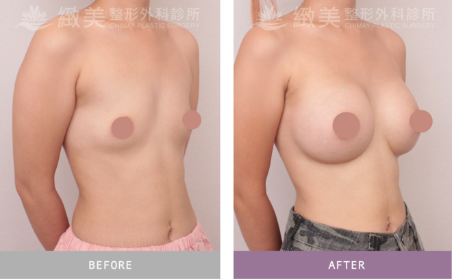 盈波隆乳 術後1個月
