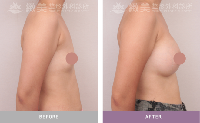 盈波隆乳 術後1個月