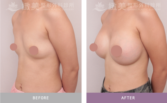 盈波隆乳 術後1個月