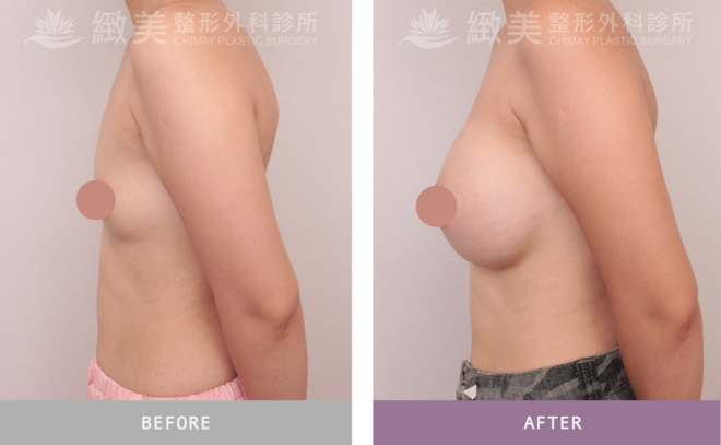 盈波隆乳 術後1個月