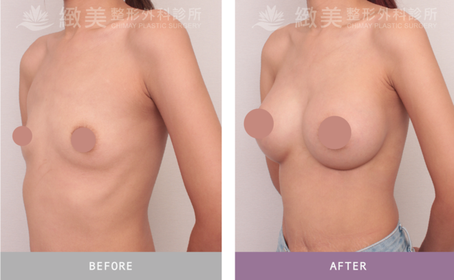 魔滴2.0隆乳 術後1個月