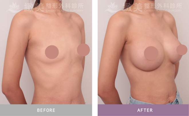 魔滴2.0隆乳 術後1個月