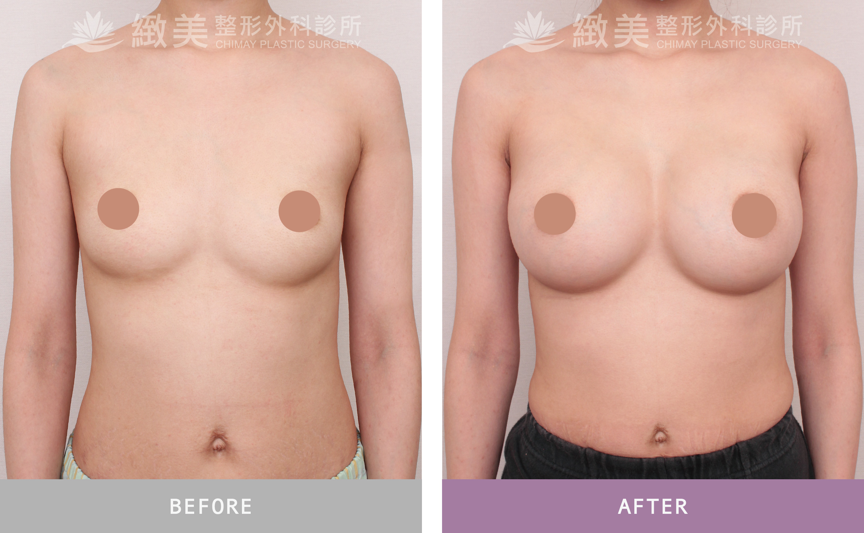 魔滴2.0隆乳 術後1個月