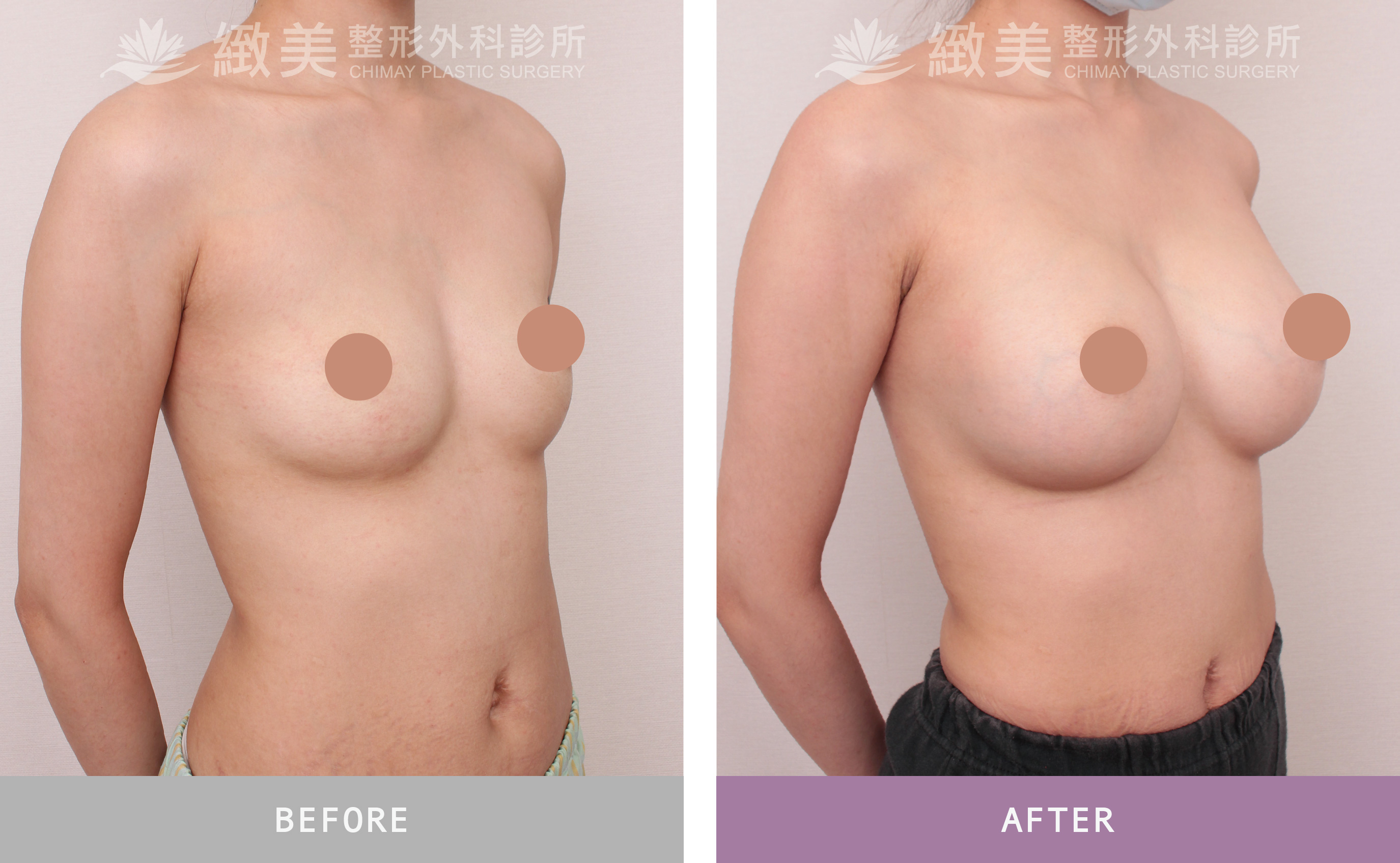 魔滴2.0隆乳 術後1個月