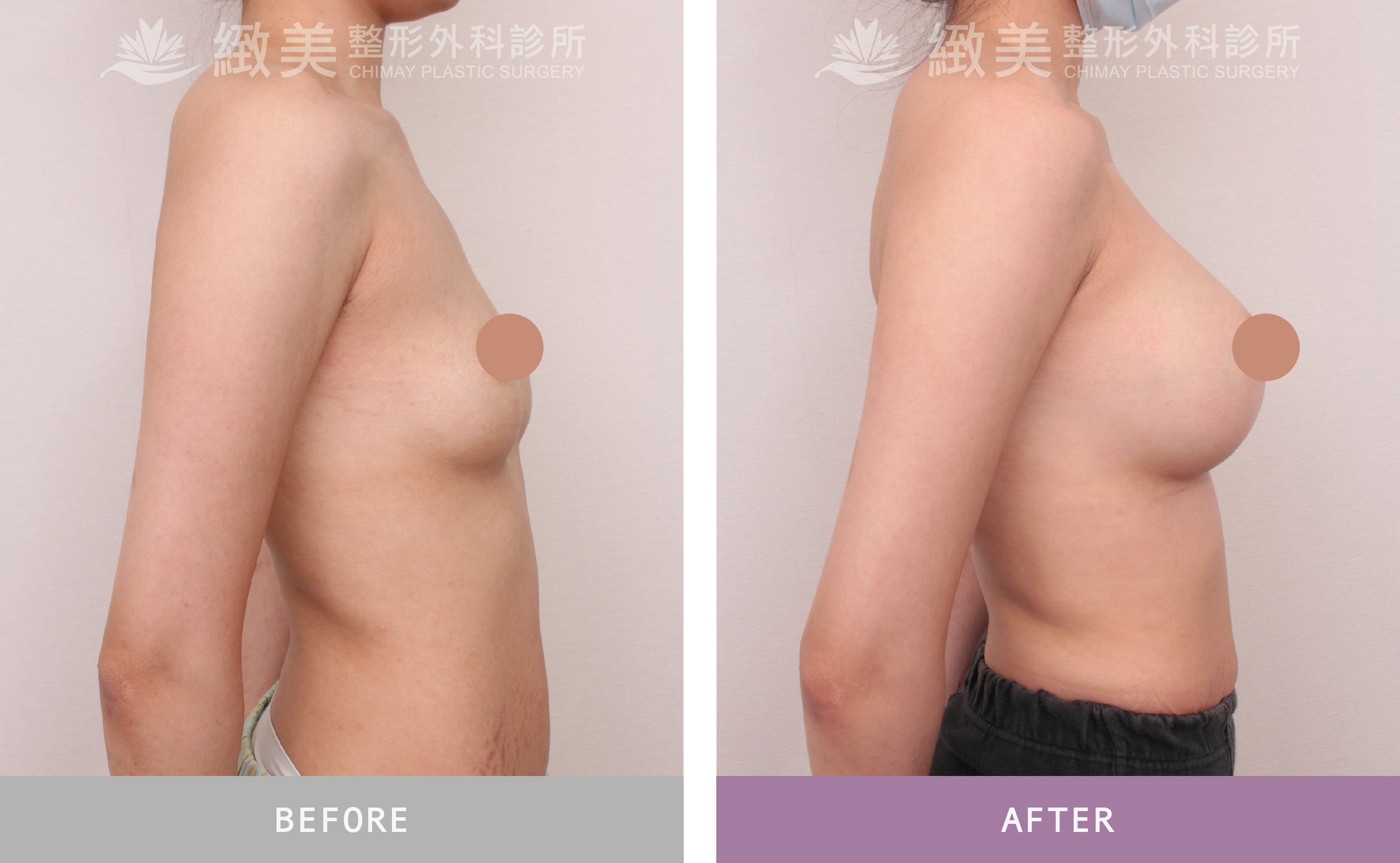 魔滴2.0隆乳 術後1個月