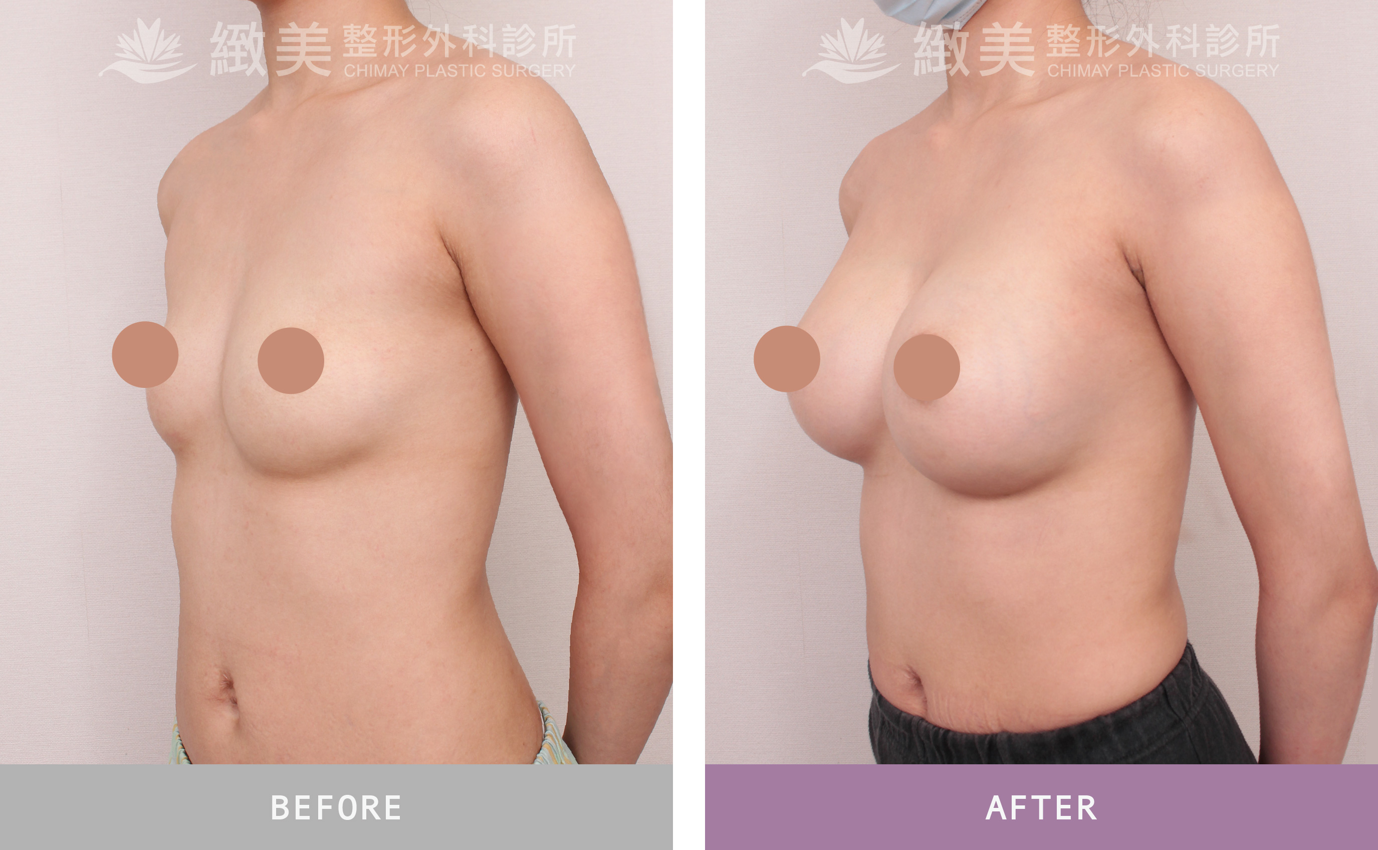 魔滴2.0隆乳 術後1個月