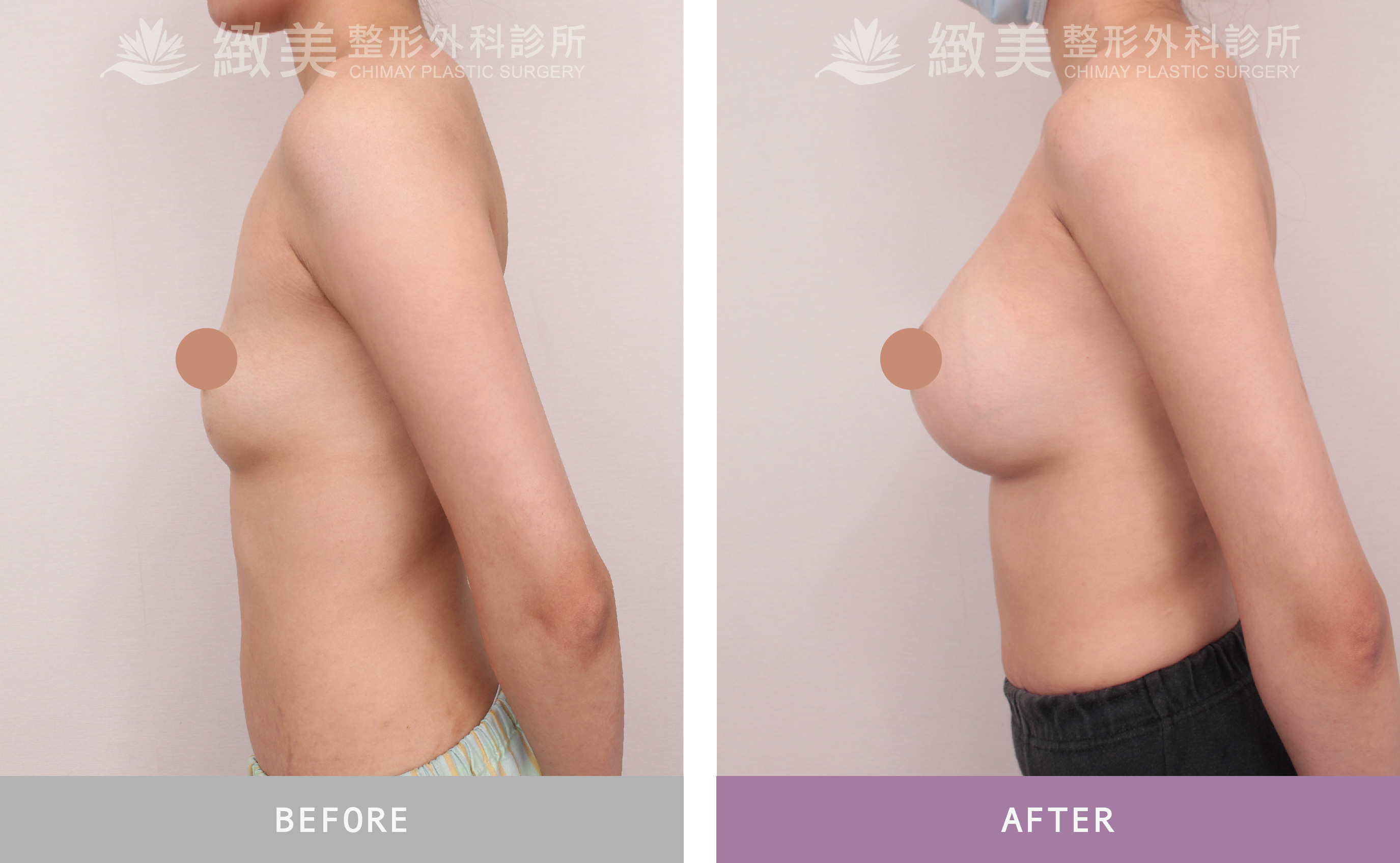 魔滴2.0隆乳 術後1個月