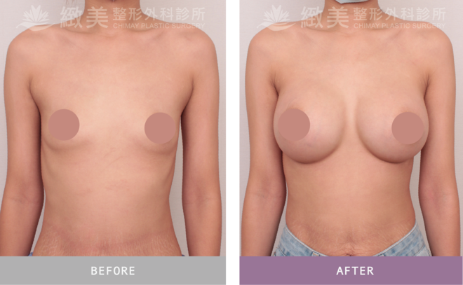 魔滴2.0隆乳 術後1個月