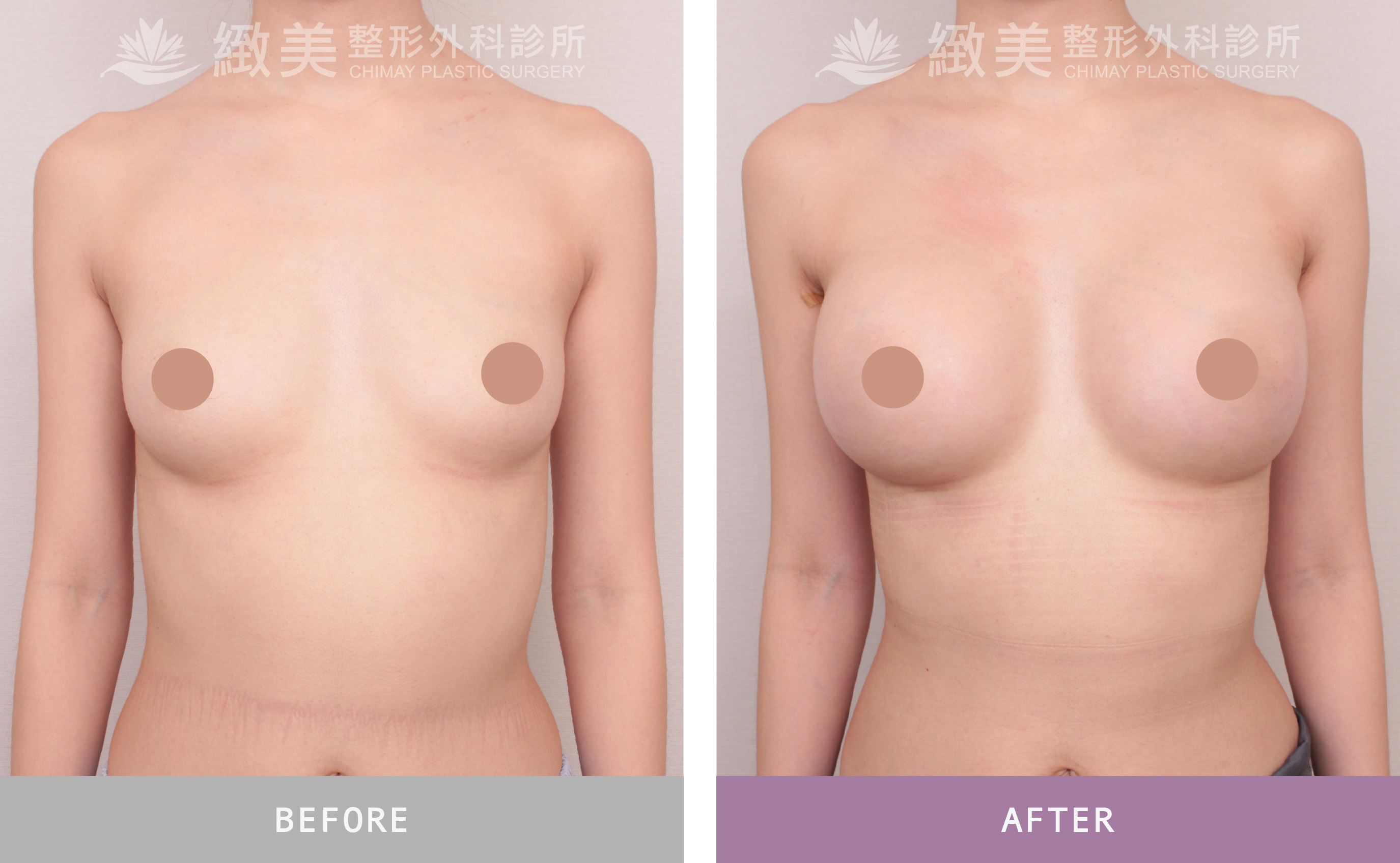 珍珠波隆乳 術後1個月