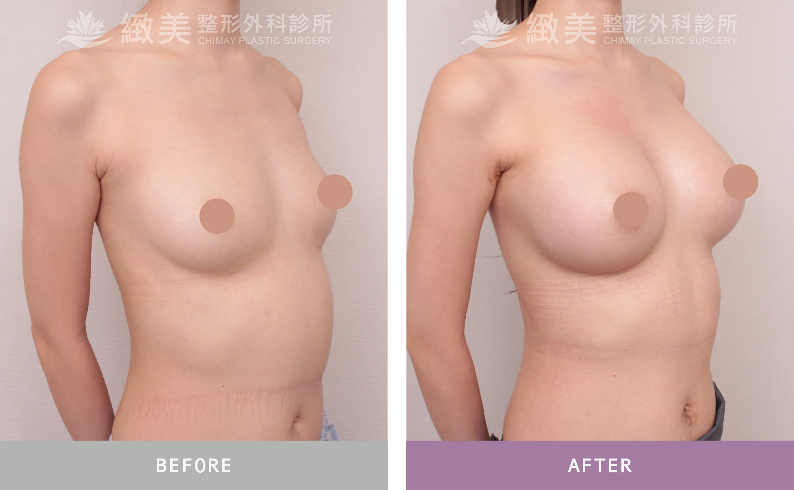 珍珠波隆乳 術後1個月