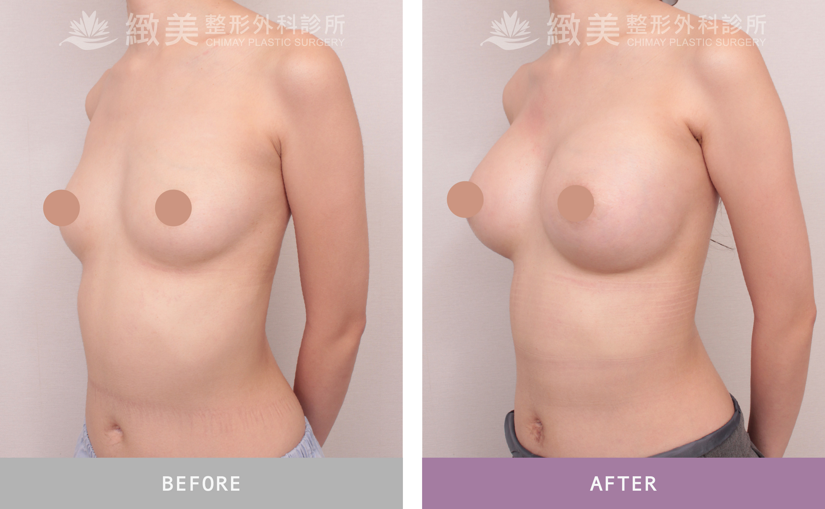 珍珠波隆乳 術後1個月