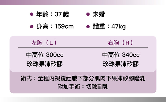 珍珠波隆乳 術後1個月