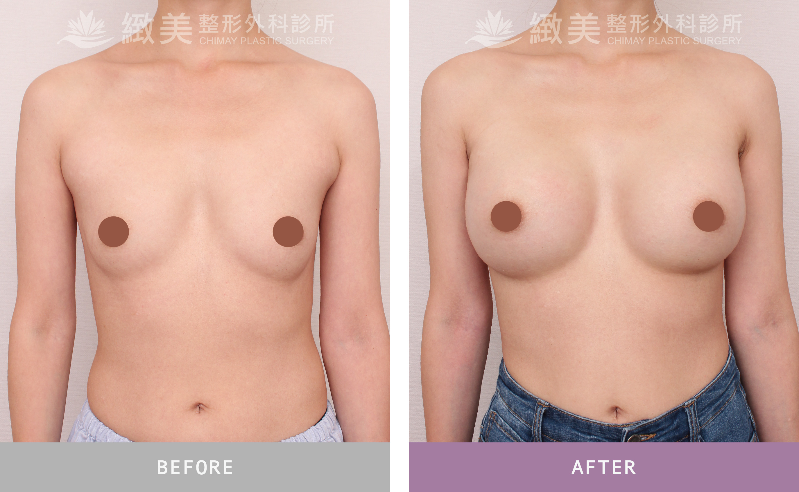 珍珠波隆乳 術後1個月