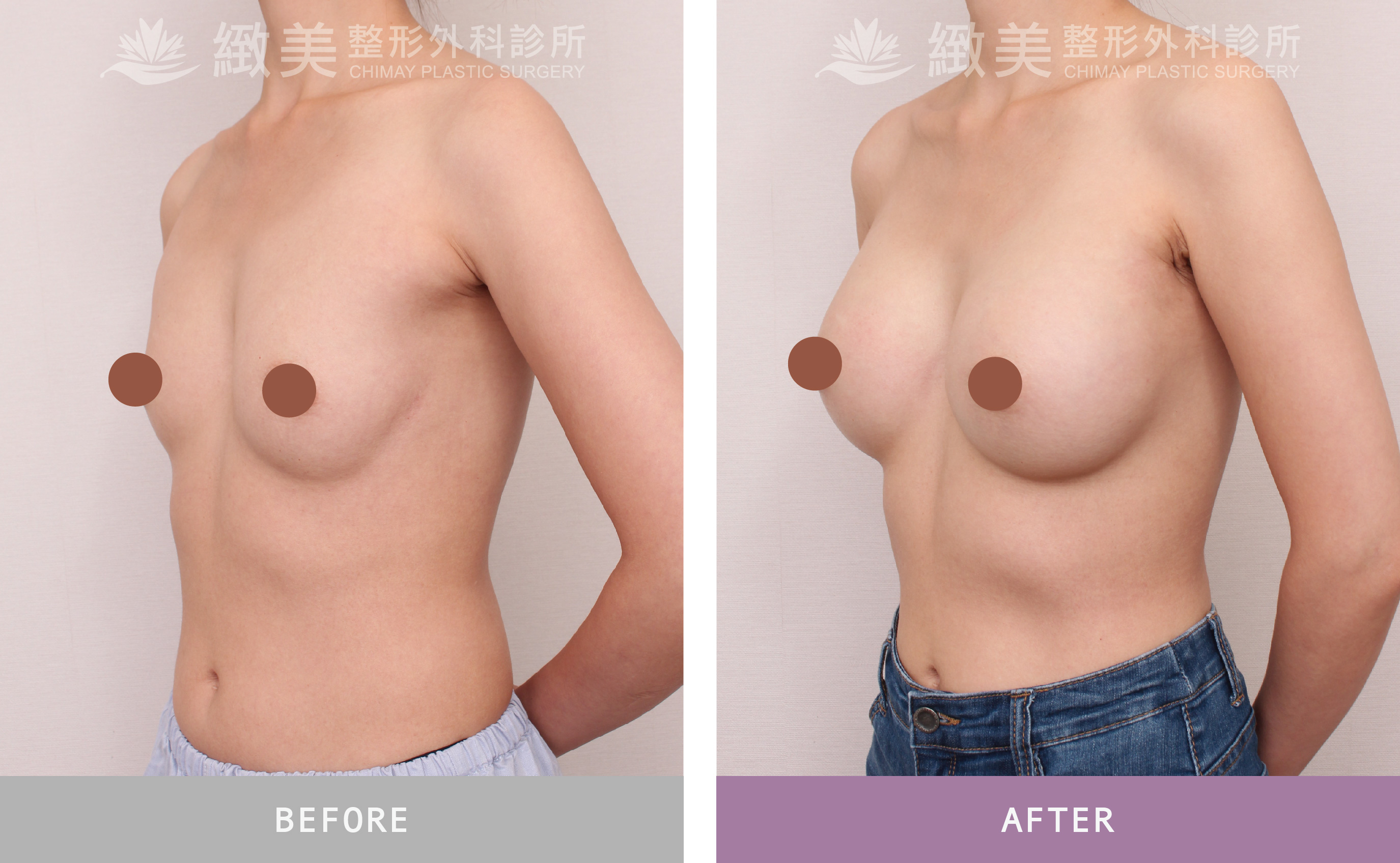 珍珠波隆乳 術後1個月