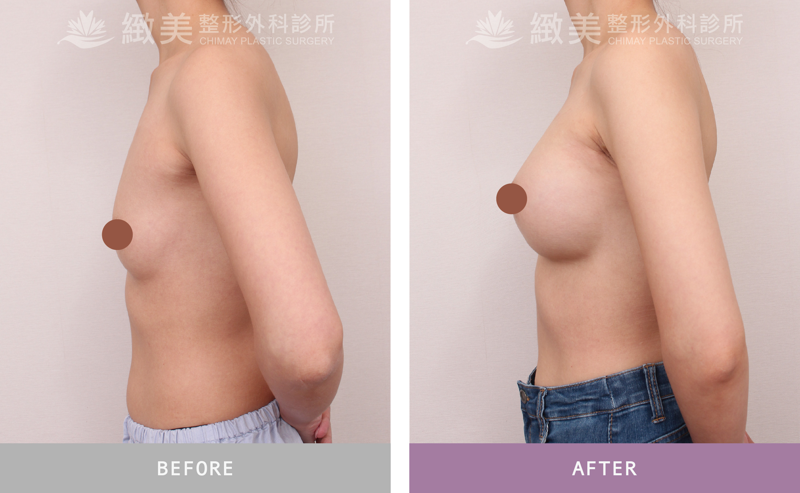 珍珠波隆乳 術後1個月