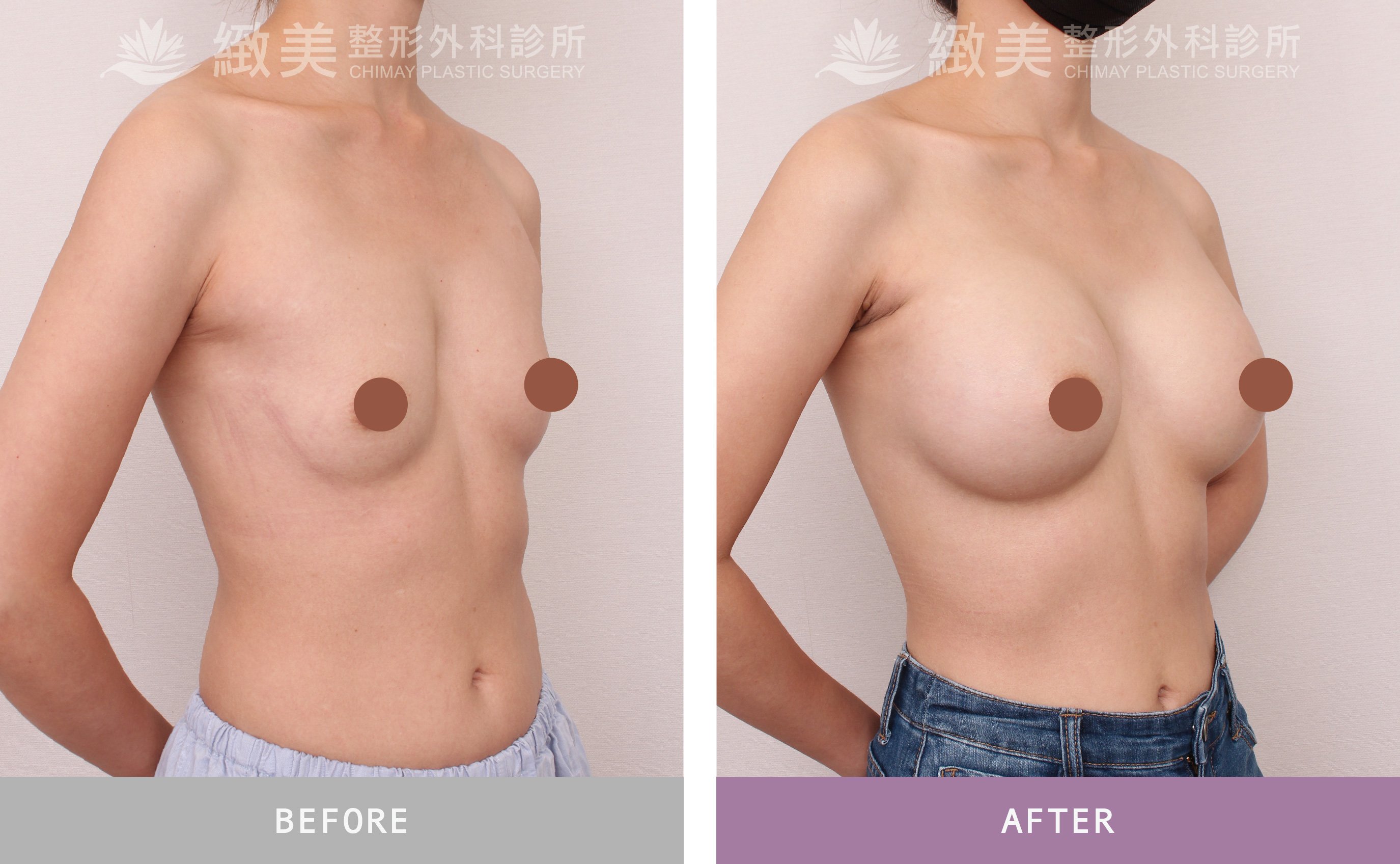 珍珠波隆乳 術後1個月