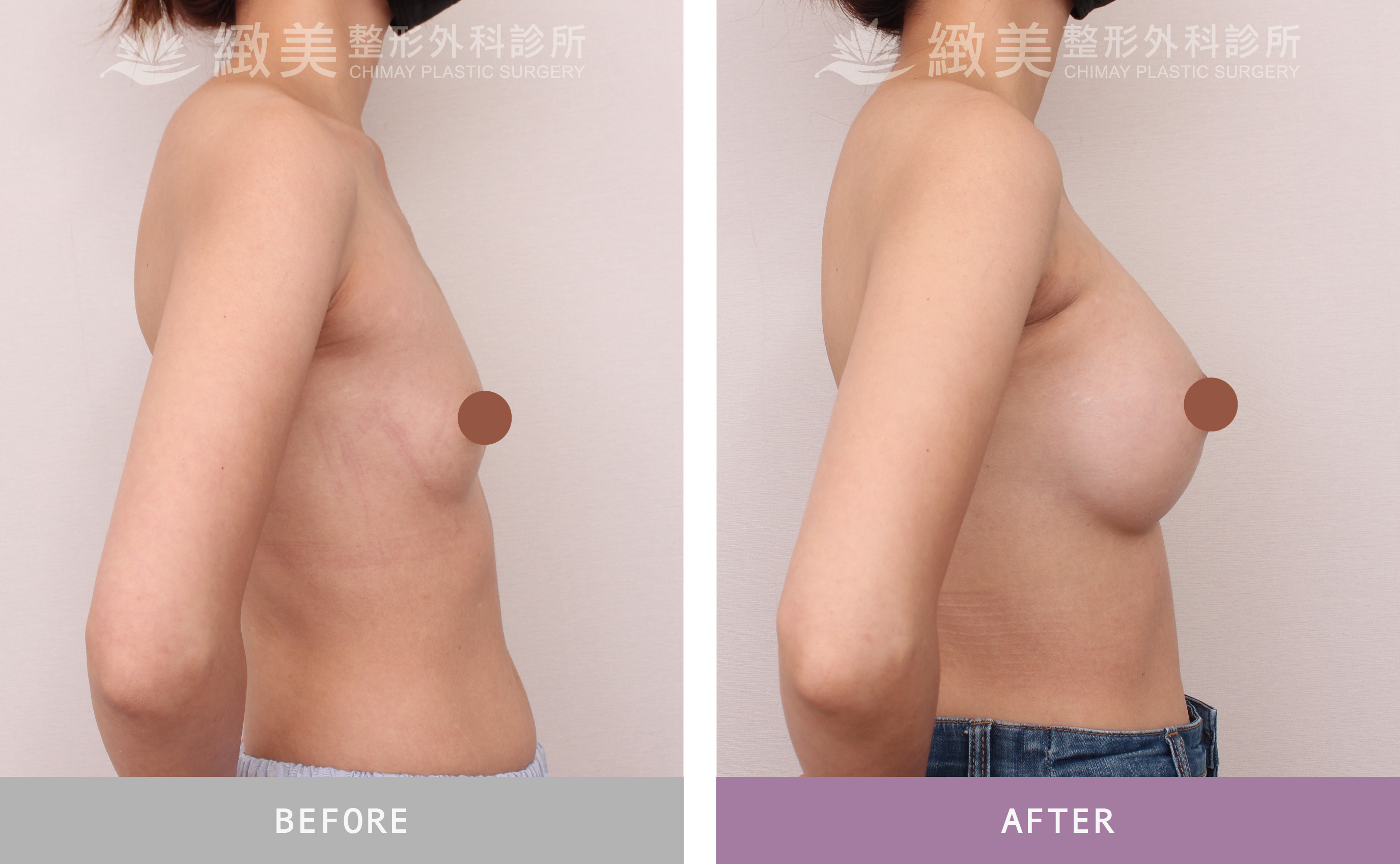 珍珠波隆乳 術後1個月