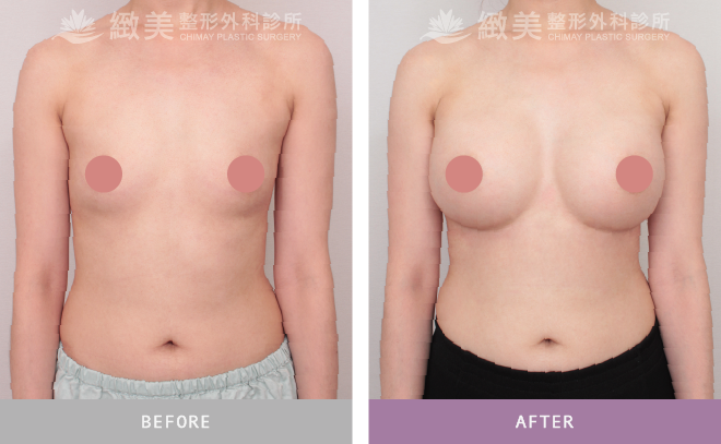 珍珠波隆乳 術後1個月