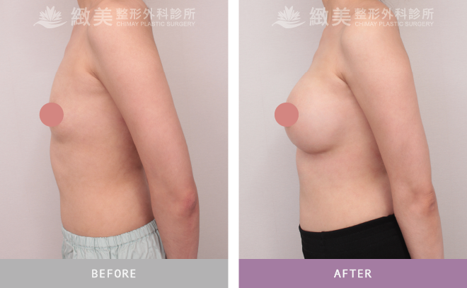 珍珠波隆乳 術後1個月