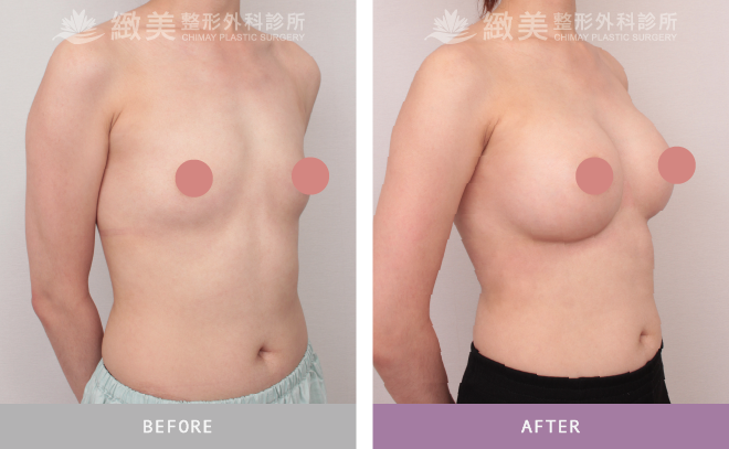 珍珠波隆乳 術後1個月