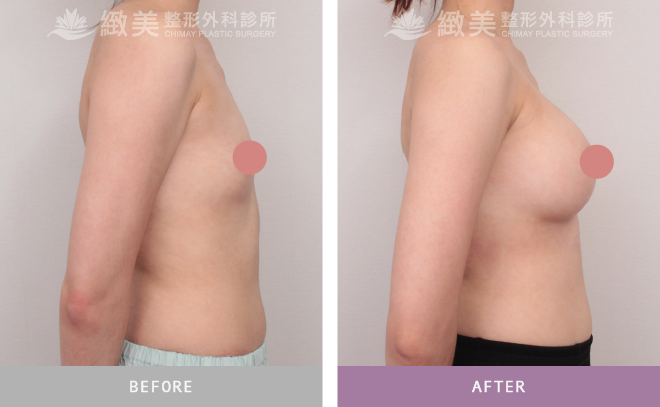 珍珠波隆乳 術後1個月