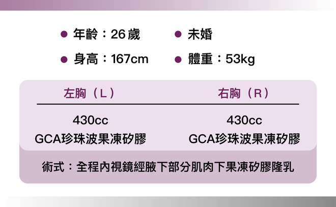 珍珠波隆乳 術後1個月