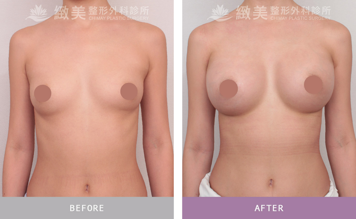 珍珠波隆乳 術後1個月