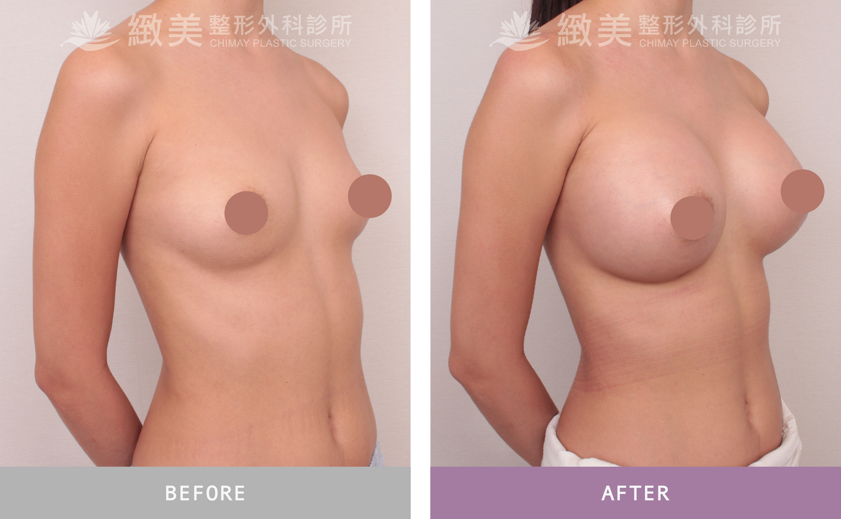 珍珠波隆乳 術後1個月