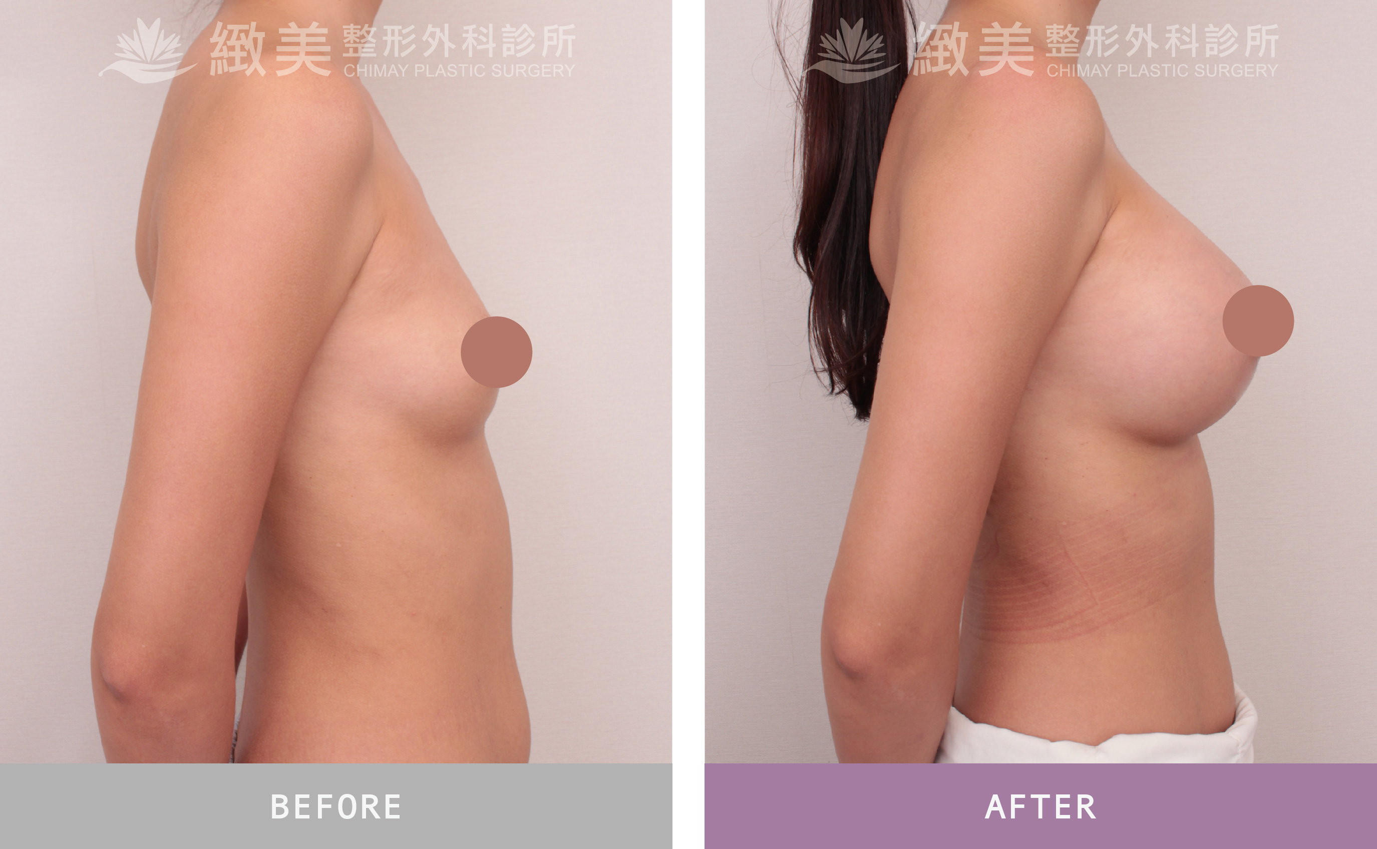 珍珠波隆乳 術後1個月