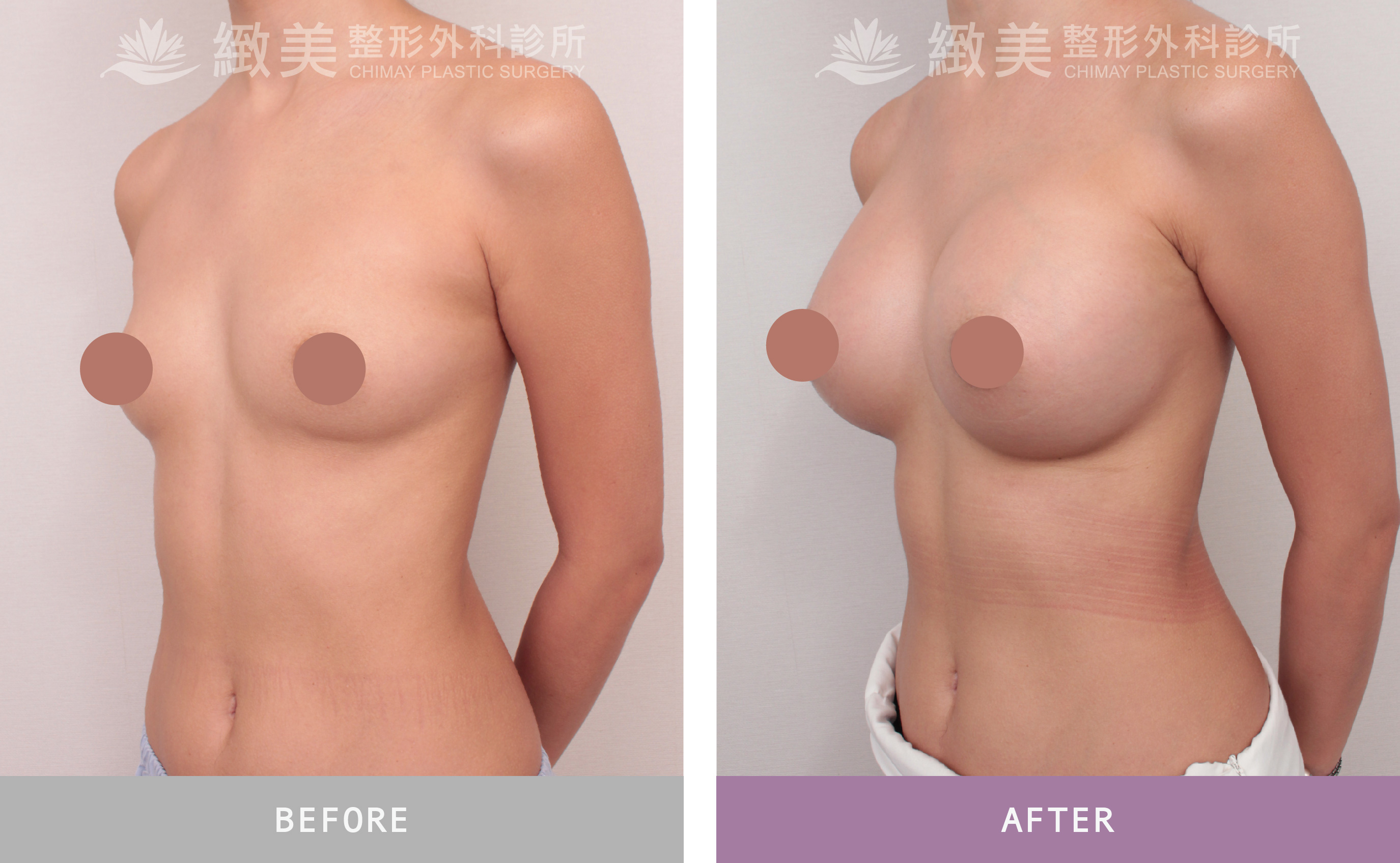 珍珠波隆乳 術後1個月