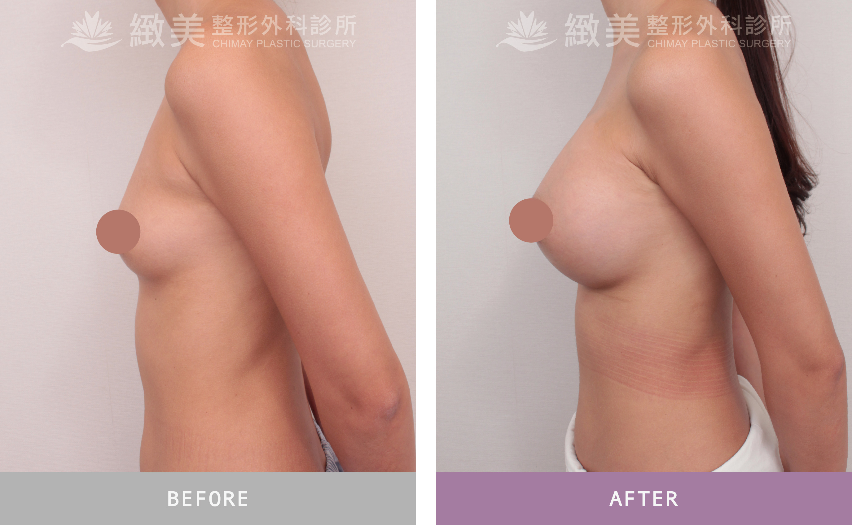 珍珠波隆乳 術後1個月