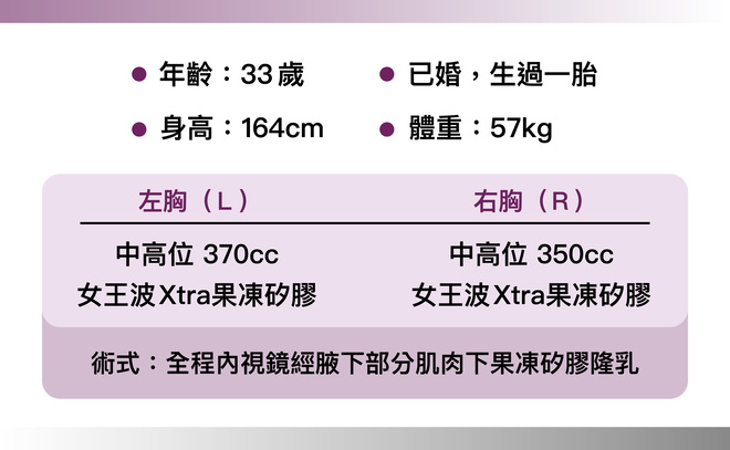 曼陀尊貴(Xtra女王波)隆乳 術後一個月