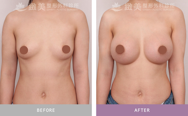 曼陀尊貴(Xtra女王波)隆乳 術後一個月