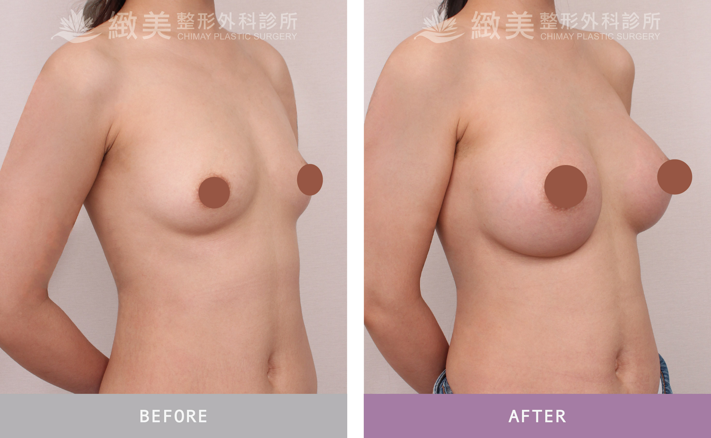 曼陀尊貴(Xtra女王波)隆乳 術後一個月曼陀