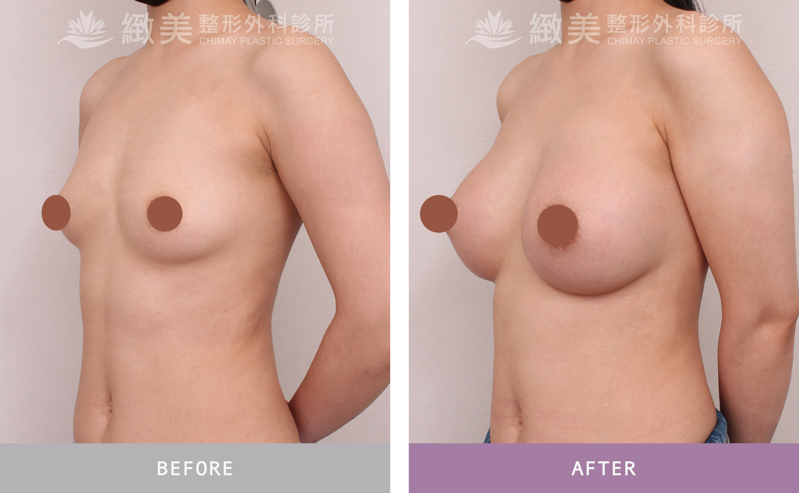 曼陀尊貴(Xtra女王波)隆乳 術後一個月