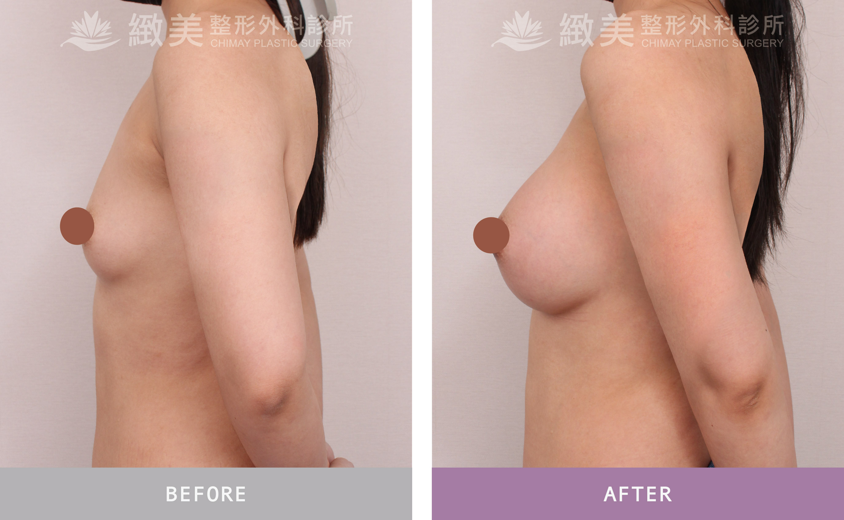 曼陀尊貴(Xtra女王波)隆乳 術後一個月