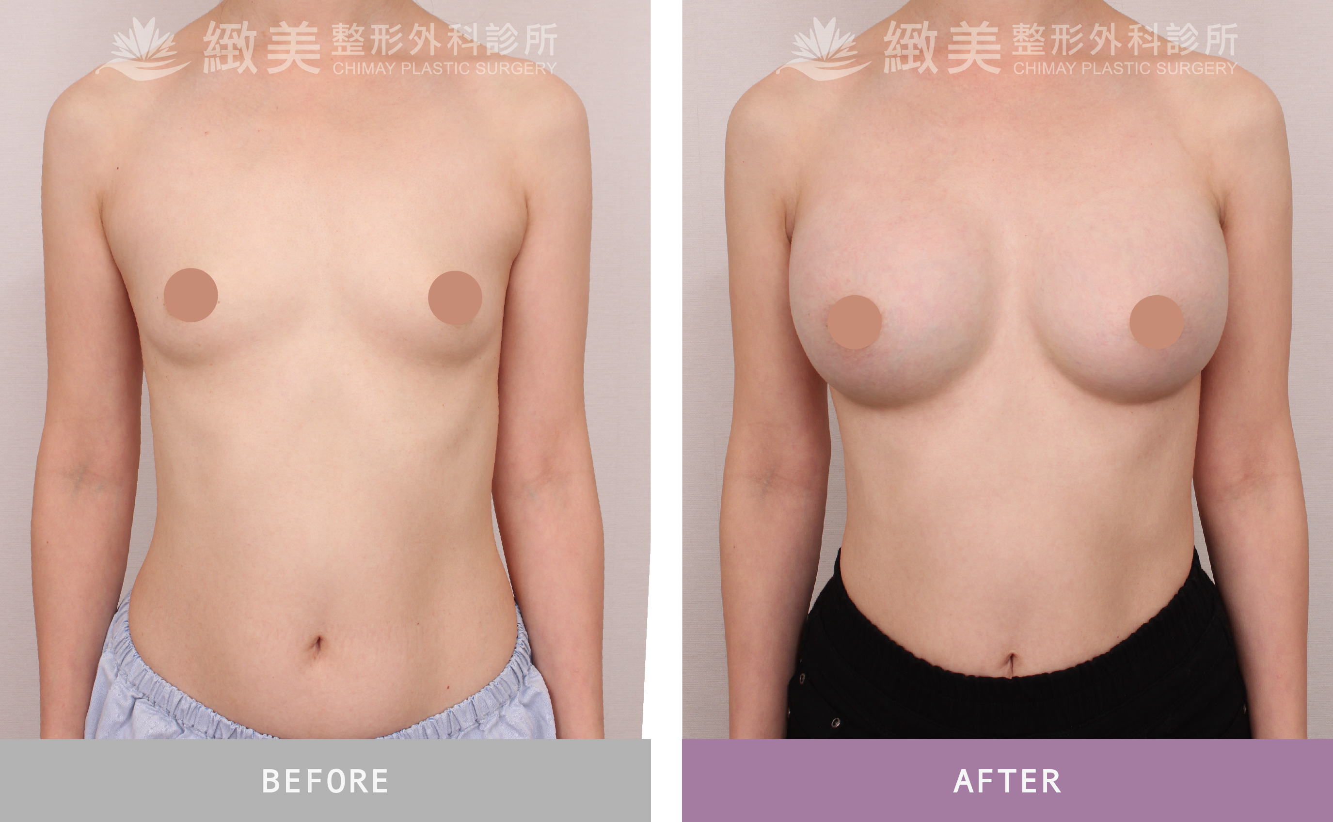 曼陀尊貴(Xtra女王波)隆乳 術後一個月