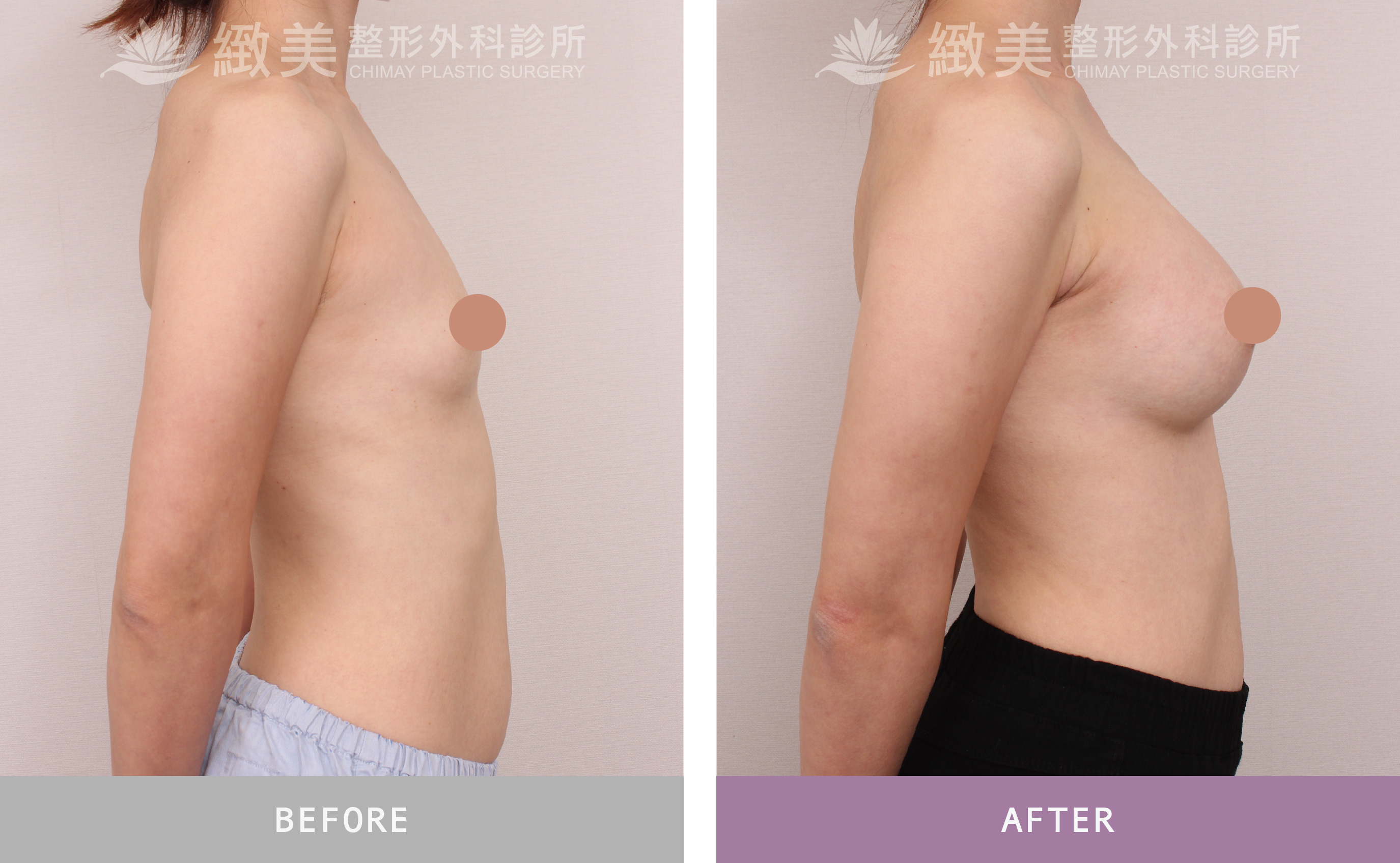 曼陀尊貴(Xtra女王波)隆乳 術後一個月