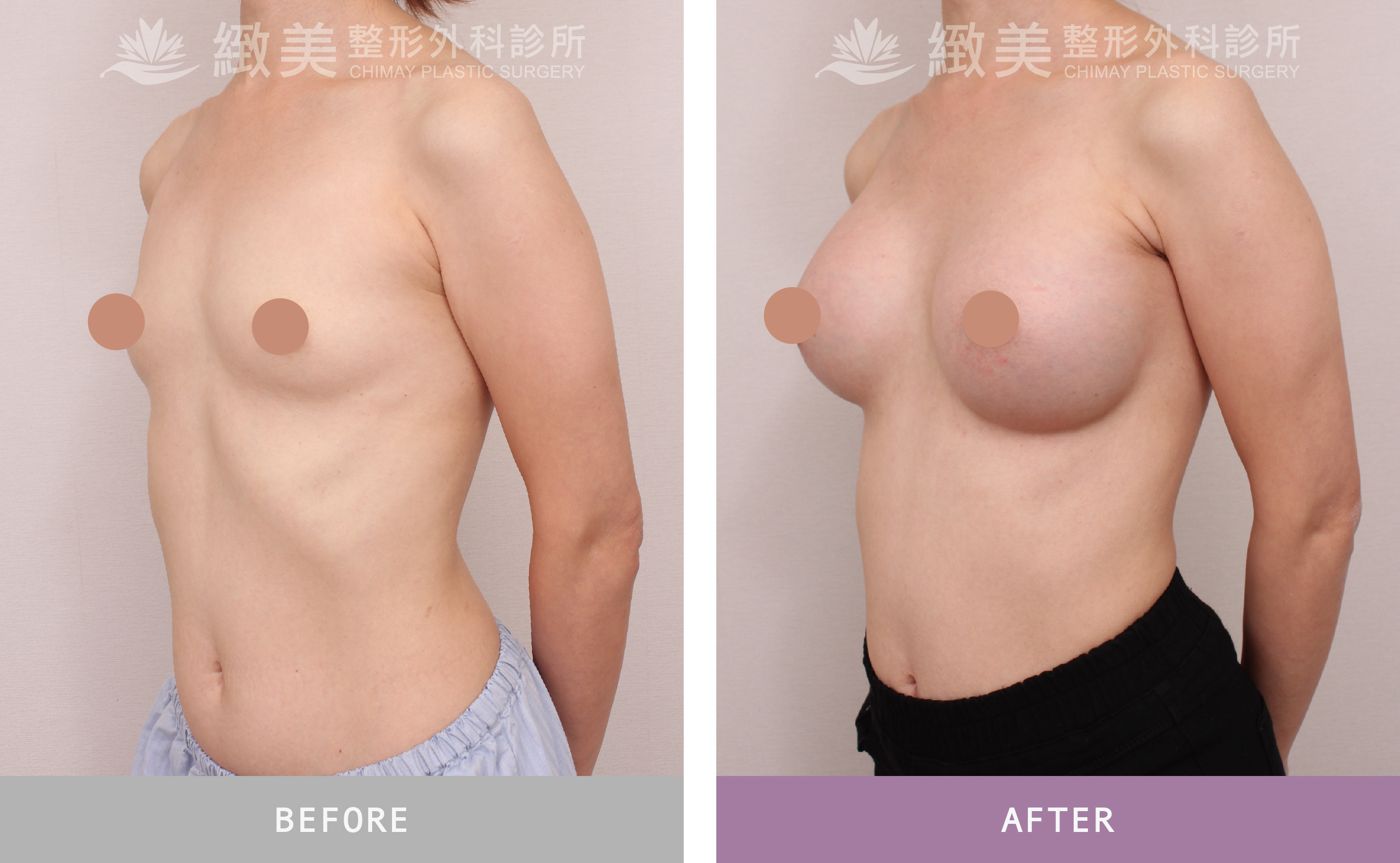 曼陀尊貴(Xtra女王波)隆乳 術後一個月